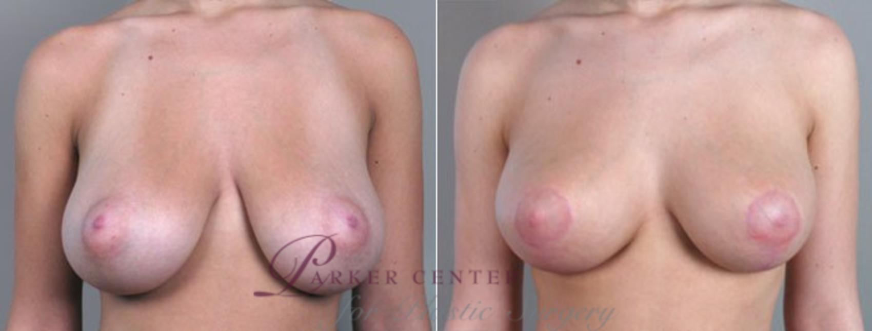 Breast Reduction Case 526 Before & After View #1 | Paramus, NJ | Parker Center for Plastic Surgery