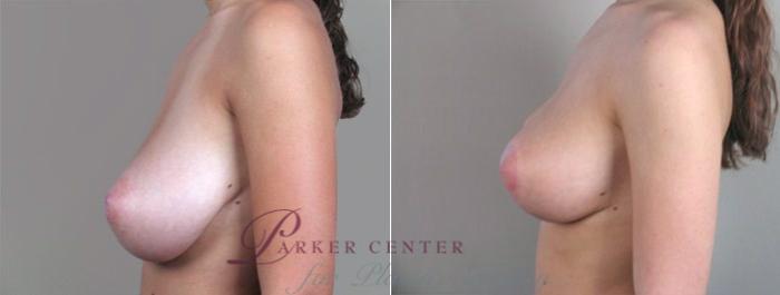 Breast Reduction Case 526 Before & After View #2 | Paramus, NJ | Parker Center for Plastic Surgery