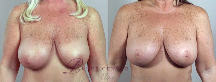 Breast Reduction Case 527 Before & After View #1 | Paramus, NJ | Parker Center for Plastic Surgery