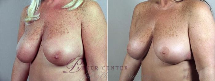 Breast Reduction Case 527 Before & After View #2 | Paramus, NJ | Parker Center for Plastic Surgery