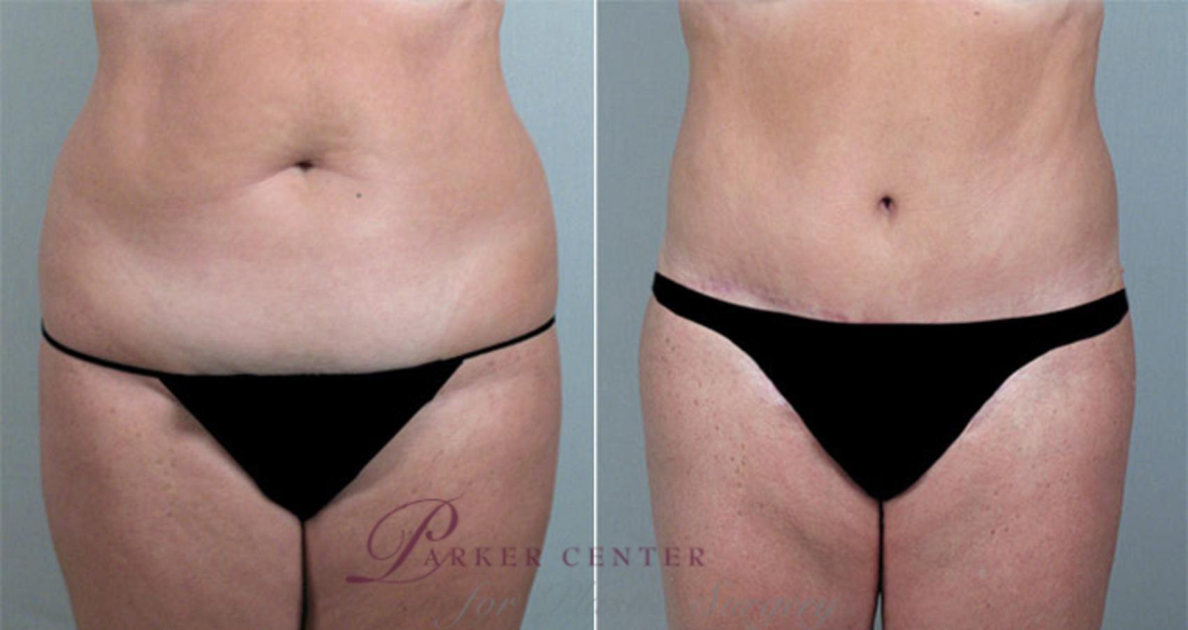 Breast Reduction Case 527 Before & After View #3 | Paramus, NJ | Parker Center for Plastic Surgery