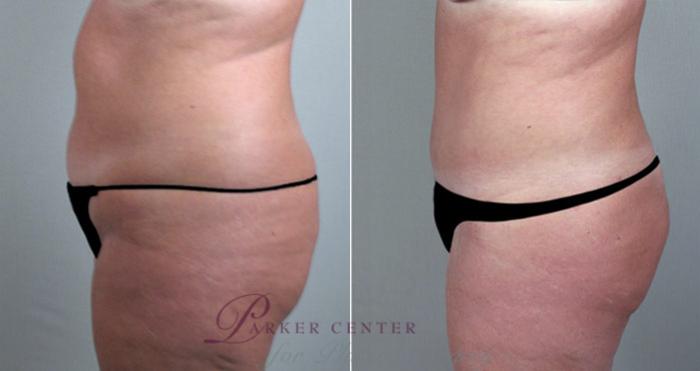 Breast Reduction Case 527 Before & After View #4 | Paramus, NJ | Parker Center for Plastic Surgery