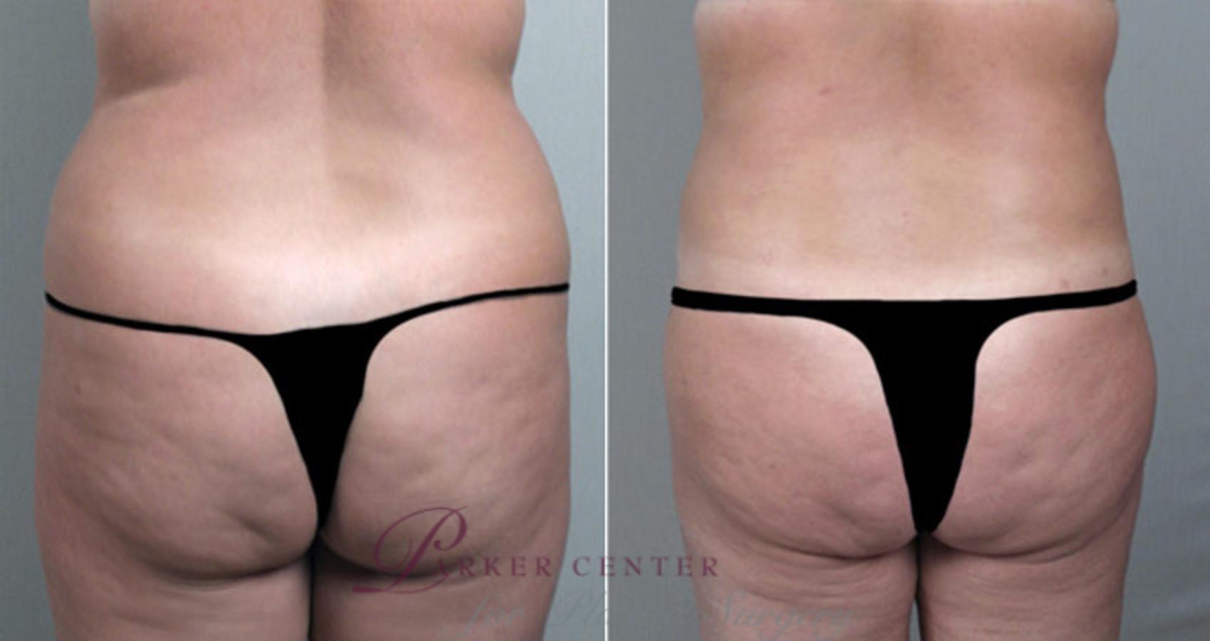 Breast Reduction Case 527 Before & After View #5 | Paramus, NJ | Parker Center for Plastic Surgery