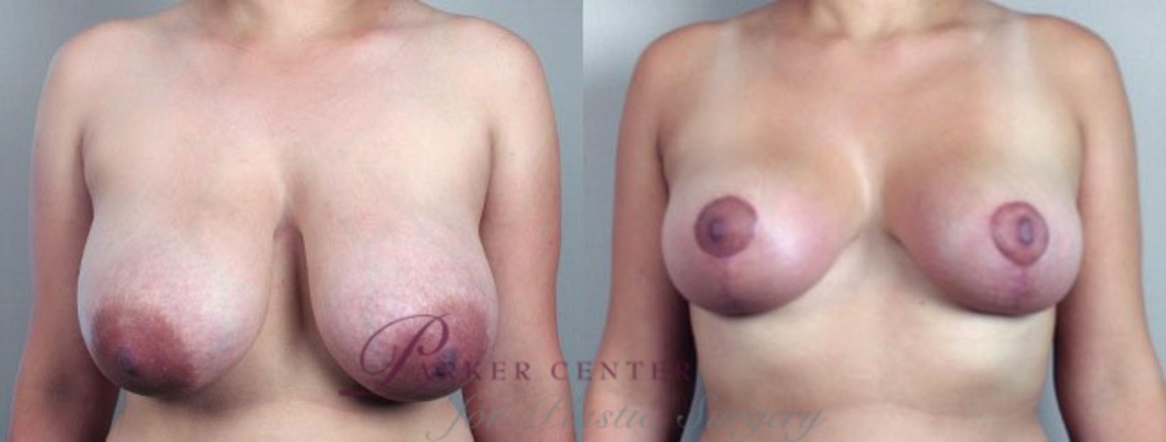 Breast Reduction Case 528 Before & After View #1 | Paramus, NJ | Parker Center for Plastic Surgery