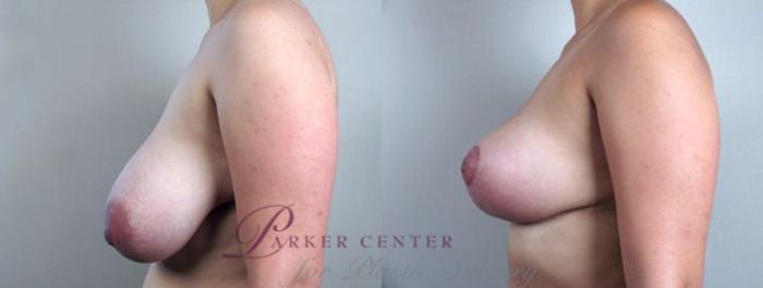 Breast Reduction Case 528 Before & After View #2 | Paramus, NJ | Parker Center for Plastic Surgery