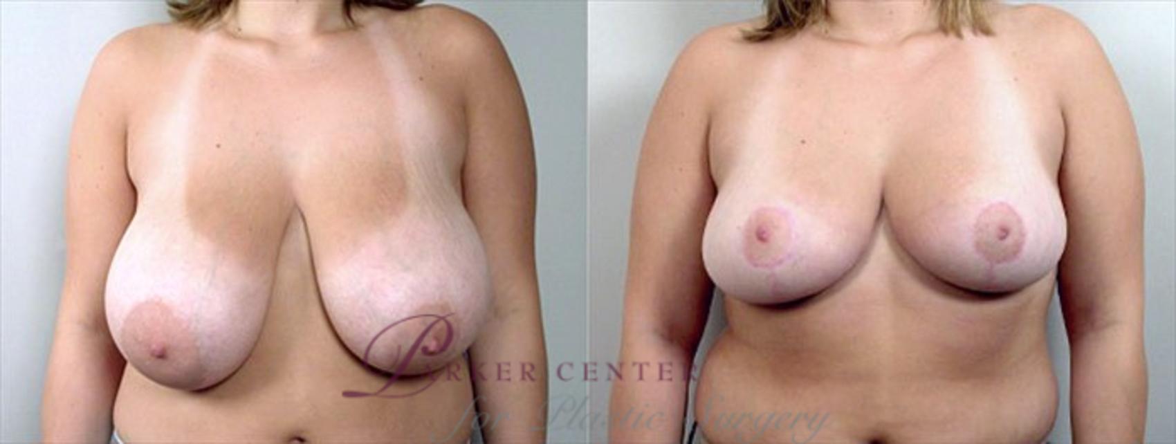 Breast Reduction Case 530 Before & After View #1 | Paramus, NJ | Parker Center for Plastic Surgery