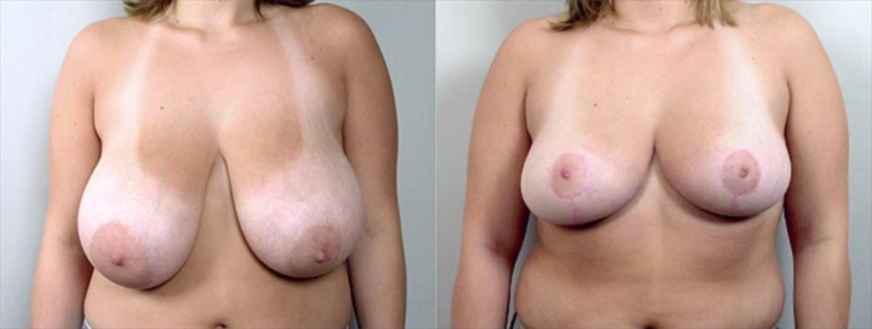 Breast Reduction Case 530 Before & After View #1 | Paramus, New Jersey | Parker Center for Plastic Surgery