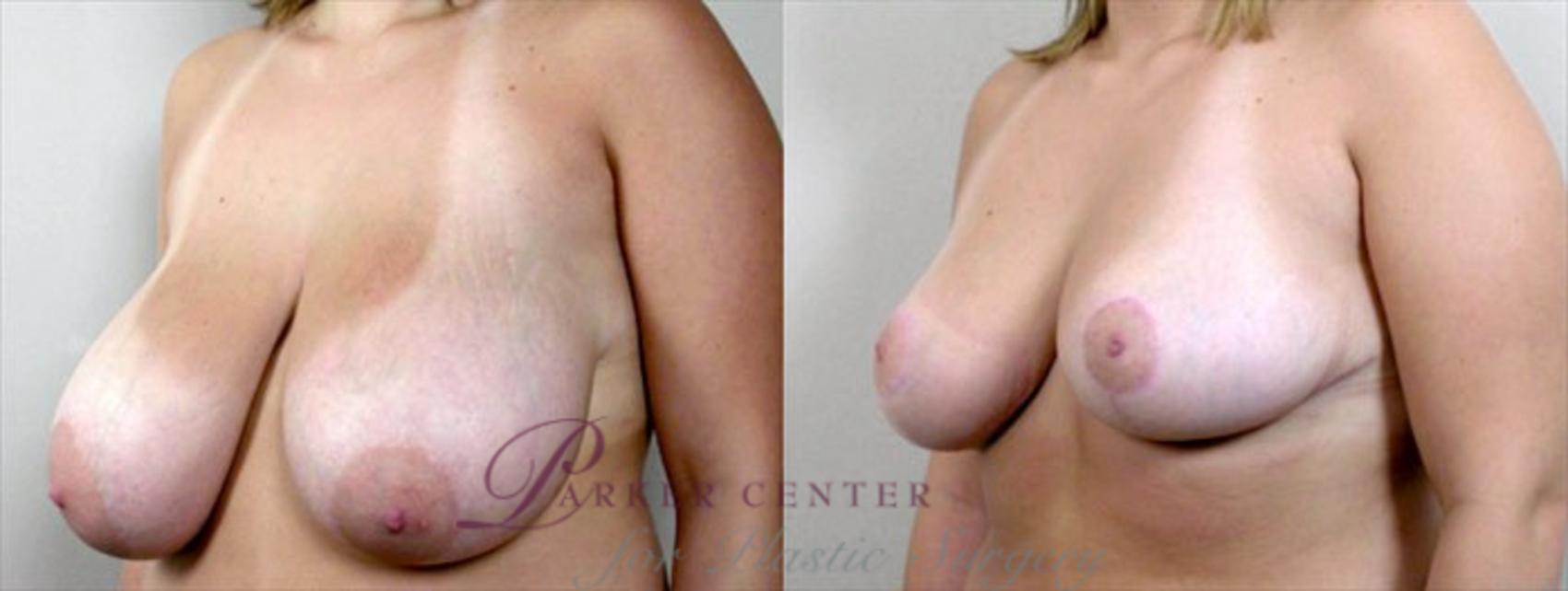 Breast Reduction Case 530 Before & After View #2 | Paramus, NJ | Parker Center for Plastic Surgery