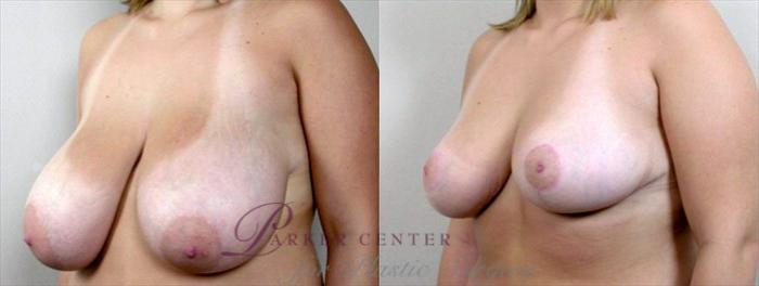 Breast Reduction Case 530 Before & After View #2 | Paramus, NJ | Parker Center for Plastic Surgery