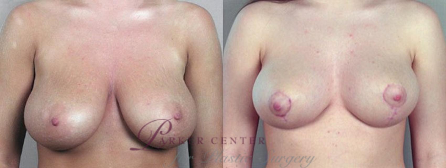 Breast Lift Case 531 Before & After View #1 | Paramus, NJ | Parker Center for Plastic Surgery