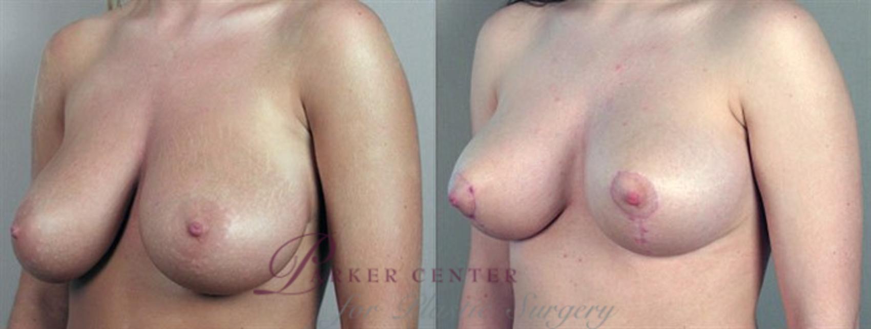 Breast Lift Case 531 Before & After View #2 | Paramus, NJ | Parker Center for Plastic Surgery