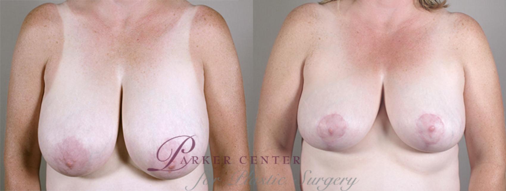 Breast Reduction Case 533 Before & After View #1 | Paramus, NJ | Parker Center for Plastic Surgery