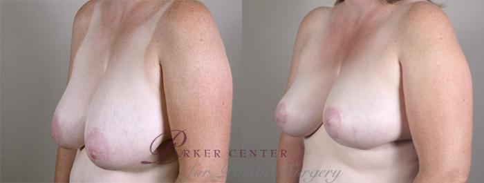 Breast Reduction Case 533 Before & After View #2 | Paramus, NJ | Parker Center for Plastic Surgery
