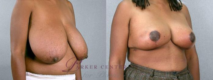 Breast Reduction Case 534 Before & After View #2 | Paramus, NJ | Parker Center for Plastic Surgery