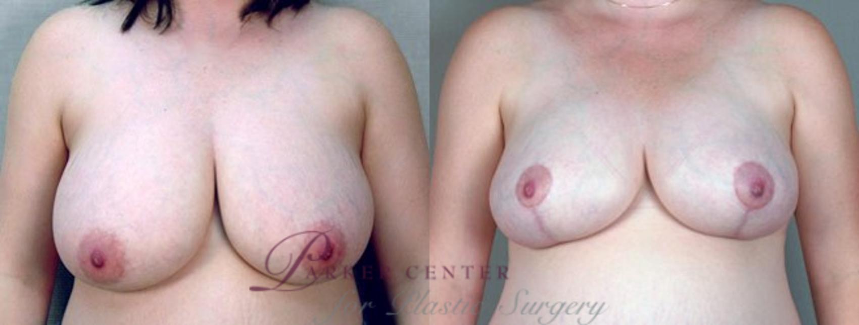 Breast Reduction Case 535 Before & After View #1 | Paramus, NJ | Parker Center for Plastic Surgery
