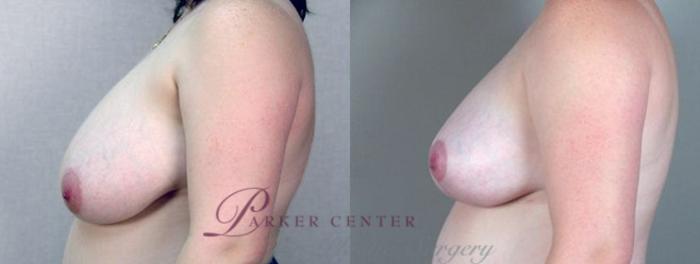 Breast Reduction Case 535 Before & After View #2 | Paramus, NJ | Parker Center for Plastic Surgery