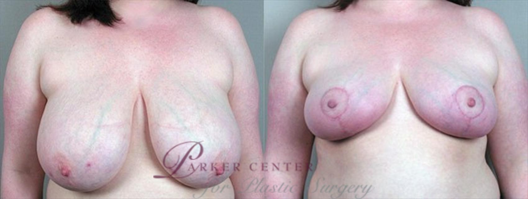 Breast Reduction Case 536 Before & After View #1 | Paramus, NJ | Parker Center for Plastic Surgery
