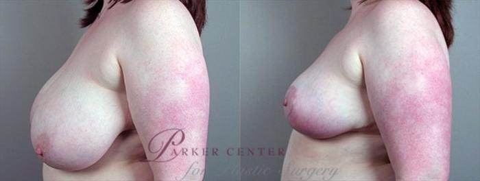 Breast Reduction Case 536 Before & After View #2 | Paramus, NJ | Parker Center for Plastic Surgery