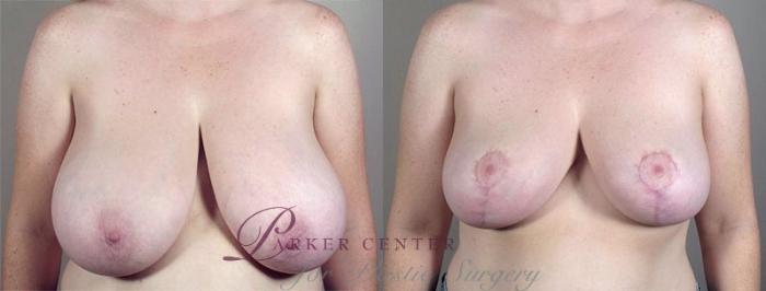 Breast Reduction Case 537 Before & After View #1 | Paramus, NJ | Parker Center for Plastic Surgery
