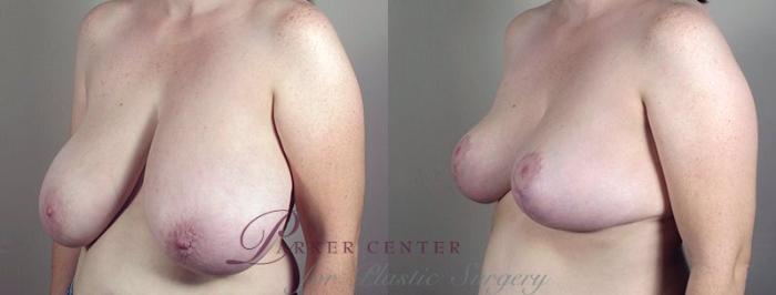Breast Reduction Case 537 Before & After View #2 | Paramus, NJ | Parker Center for Plastic Surgery