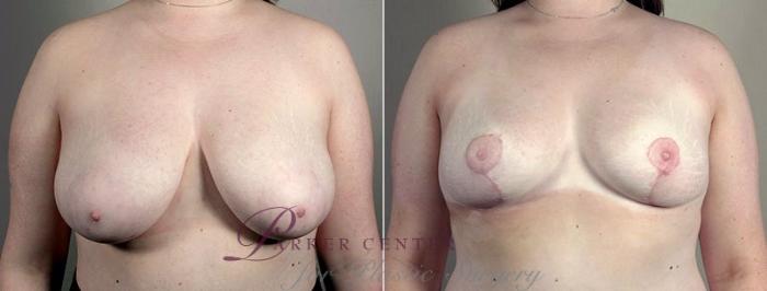 Breast Reduction Case 539 Before & After View #1 | Paramus, NJ | Parker Center for Plastic Surgery