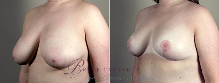 Breast Reduction Case 539 Before & After View #2 | Paramus, NJ | Parker Center for Plastic Surgery