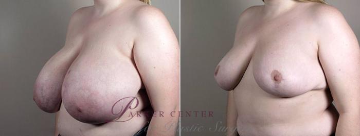 Breast Reduction Case 540 Before & After View #1 | Paramus, NJ | Parker Center for Plastic Surgery