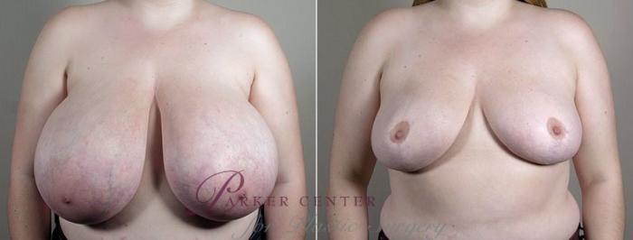 Breast Reduction Case 540 Before & After View #2 | Paramus, NJ | Parker Center for Plastic Surgery
