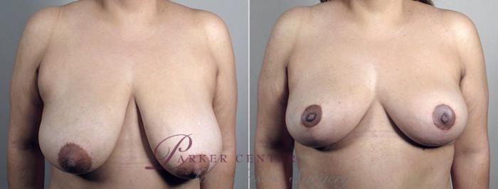 Breast Reduction Case 541 Before & After View #1 | Paramus, NJ | Parker Center for Plastic Surgery