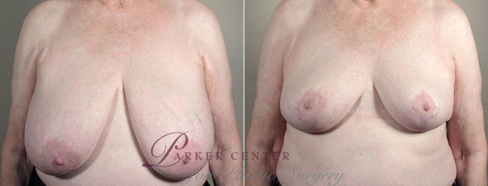 Breast Reduction Case 542 Before & After View #1 | Paramus, NJ | Parker Center for Plastic Surgery