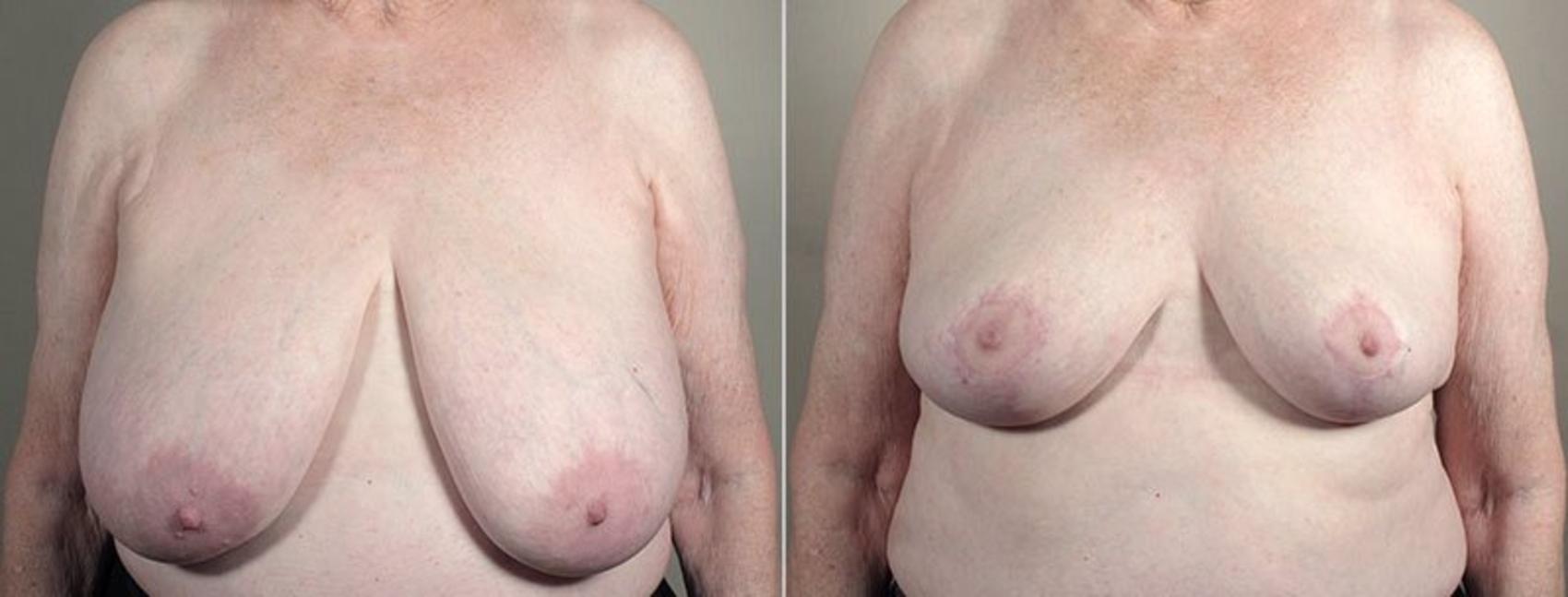 Breast Reduction Case 542 Before & After View #1 | Paramus, NJ | Parker Center for Plastic Surgery