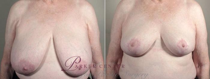 Breast Reduction Case 542 Before & After View #1 | Paramus, NJ | Parker Center for Plastic Surgery