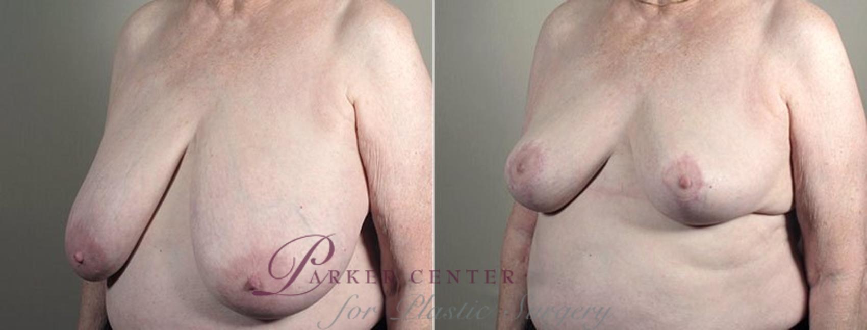 Breast Reduction Case 542 Before & After View #2 | Paramus, NJ | Parker Center for Plastic Surgery