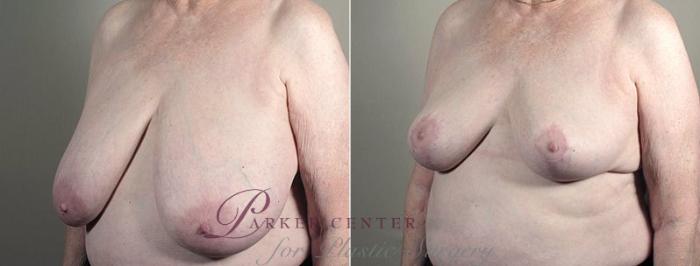 Breast Reduction Case 542 Before & After View #2 | Paramus, NJ | Parker Center for Plastic Surgery