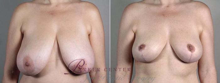 Breast Reduction Case 543 Before & After View #1 | Paramus, NJ | Parker Center for Plastic Surgery