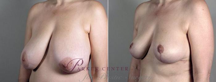 Breast Reduction Case 543 Before & After View #2 | Paramus, NJ | Parker Center for Plastic Surgery