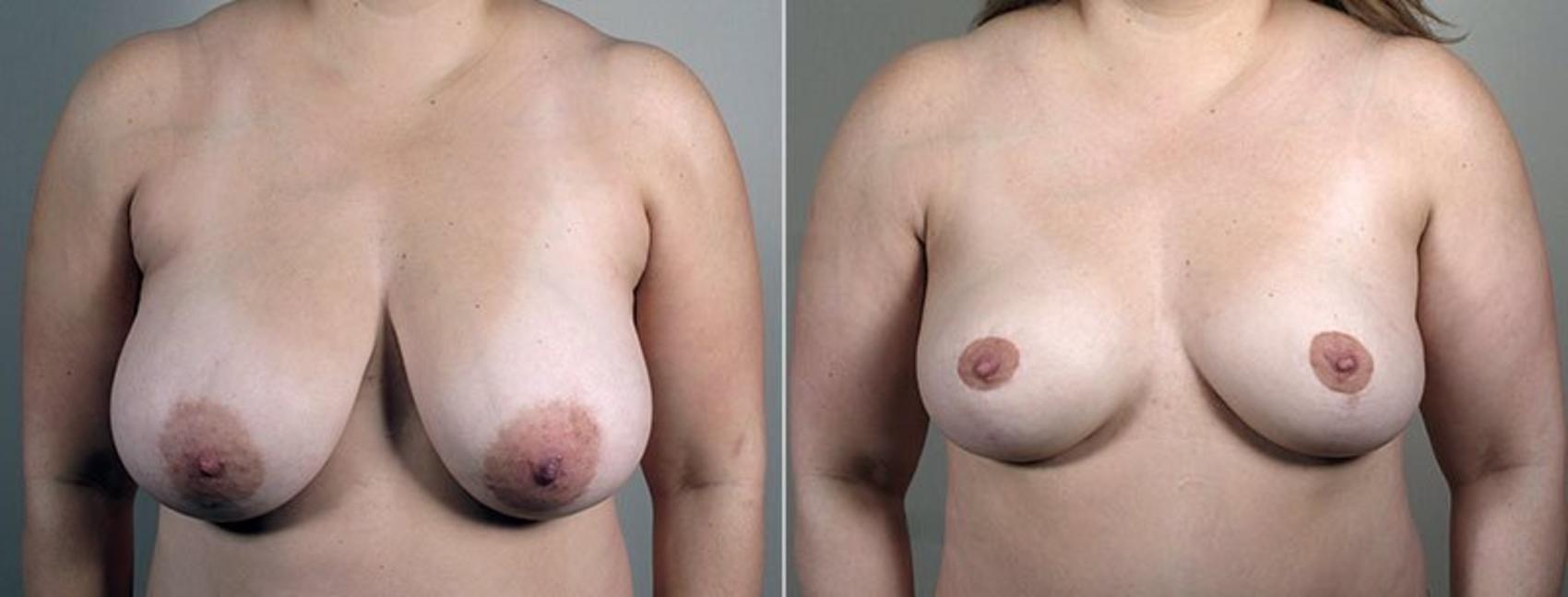 Breast Reduction Case 544 Before & After View #1 | Paramus, NJ | Parker Center for Plastic Surgery