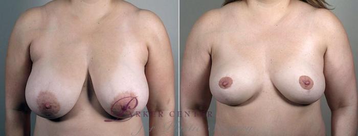Breast Reduction Case 544 Before & After View #1 | Paramus, NJ | Parker Center for Plastic Surgery