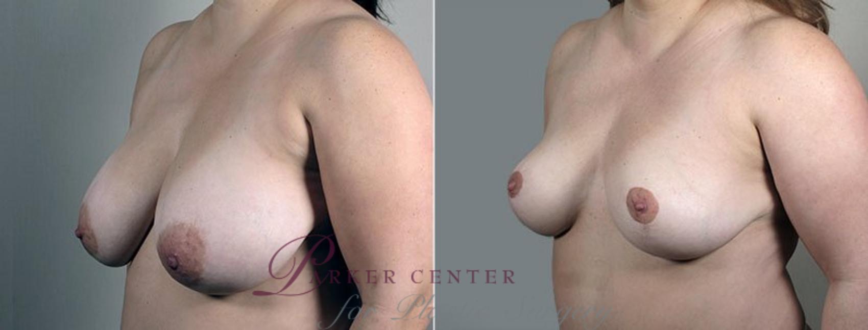 Breast Reduction Case 544 Before & After View #2 | Paramus, NJ | Parker Center for Plastic Surgery