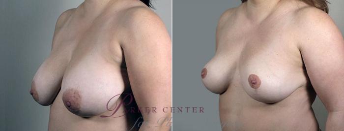 Breast Reduction Case 544 Before & After View #2 | Paramus, NJ | Parker Center for Plastic Surgery