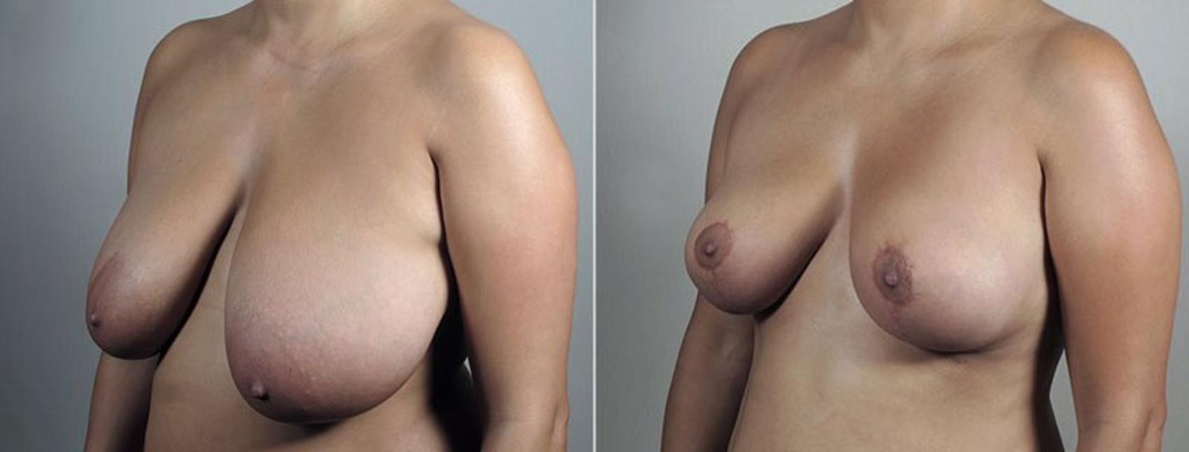 Breast Reduction Case 545 Before & After View #1 | Paramus, NJ | Parker Center for Plastic Surgery