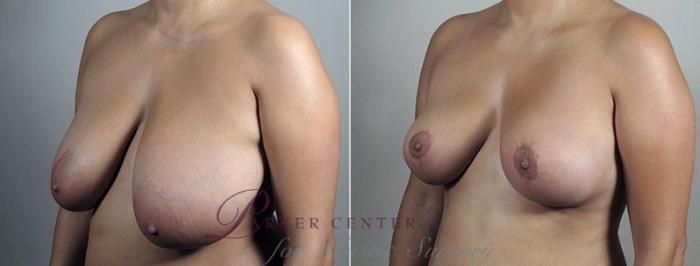 Breast Reduction Case 545 Before & After View #1 | Paramus, NJ | Parker Center for Plastic Surgery