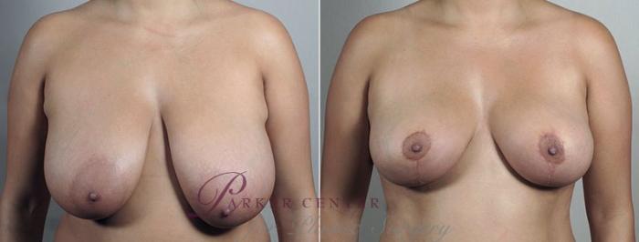 Breast Reduction Case 545 Before & After View #2 | Paramus, NJ | Parker Center for Plastic Surgery