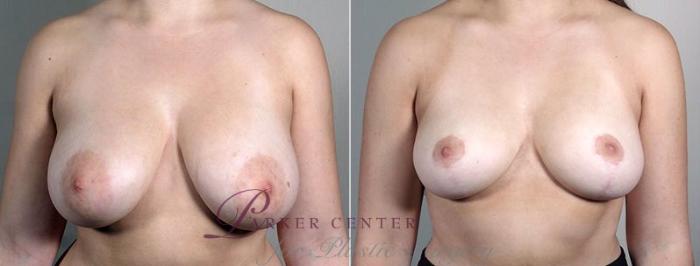 Breast Reduction Case 546 Before & After View #1 | Paramus, NJ | Parker Center for Plastic Surgery