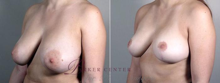 Breast Reduction Case 546 Before & After View #2 | Paramus, NJ | Parker Center for Plastic Surgery