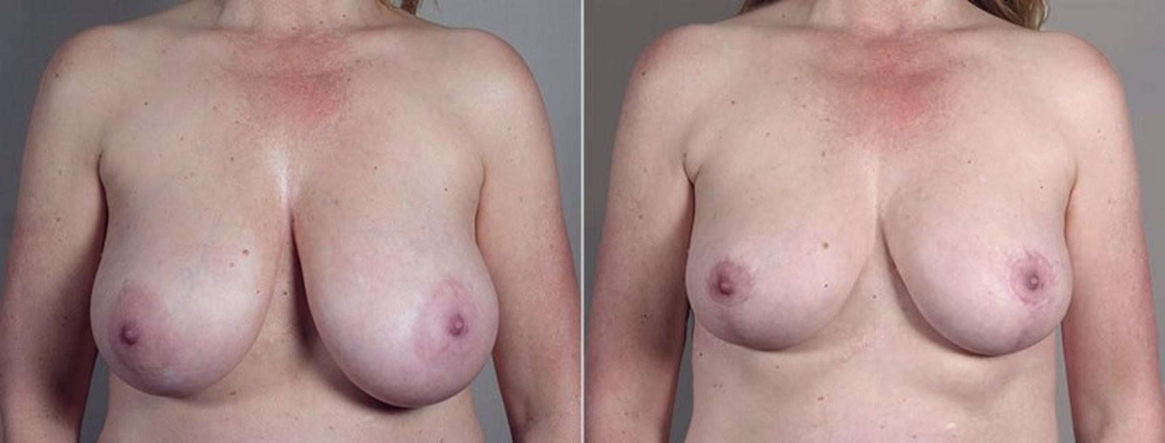 Breast Reduction Case 547 Before & After View #1 | Paramus, New Jersey | Parker Center for Plastic Surgery