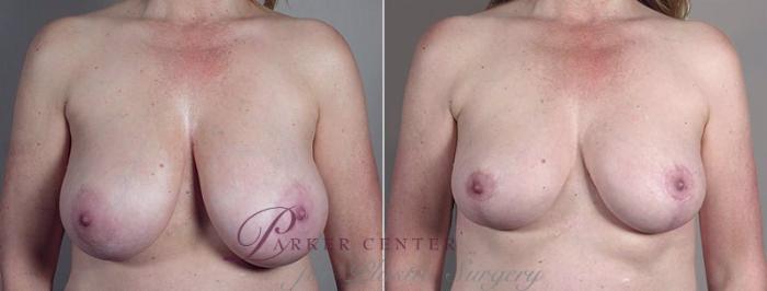 Breast Reduction Case 547 Before & After View #1 | Paramus, NJ | Parker Center for Plastic Surgery