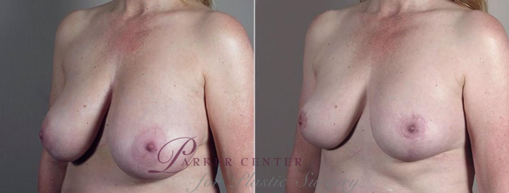 Breast Reduction Case 547 Before & After View #2 | Paramus, NJ | Parker Center for Plastic Surgery