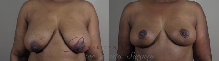 Breast Reduction Case 980 Before & After Front | Paramus, NJ | Parker Center for Plastic Surgery