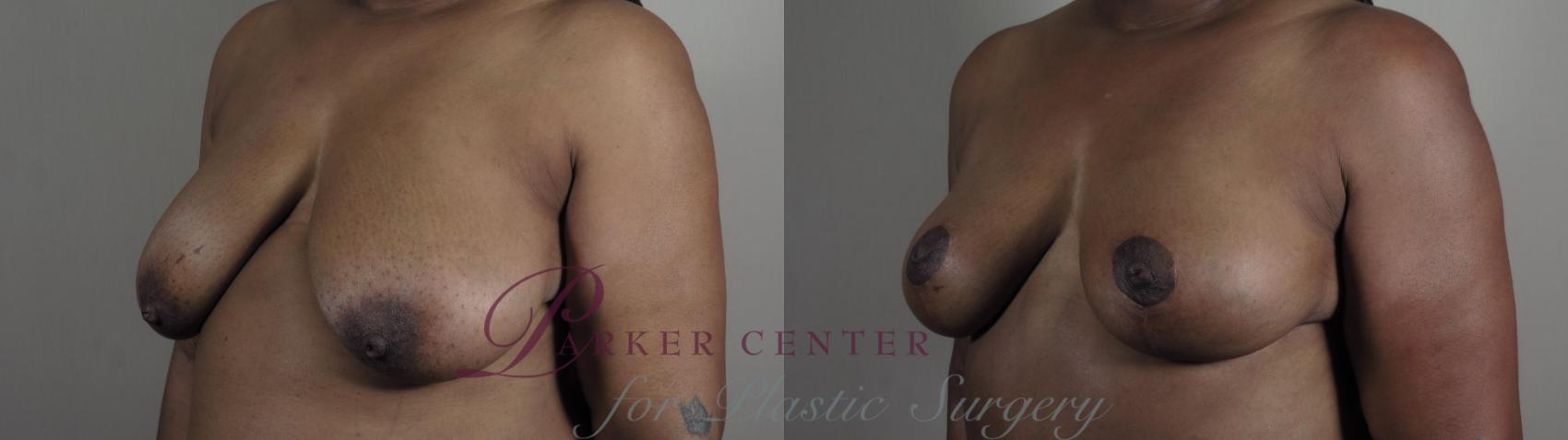 Breast Reduction Case 980 Before & After Right Oblique | Paramus, NJ | Parker Center for Plastic Surgery